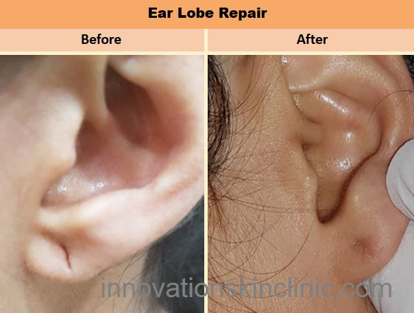 Ear-Lobe Repair 2